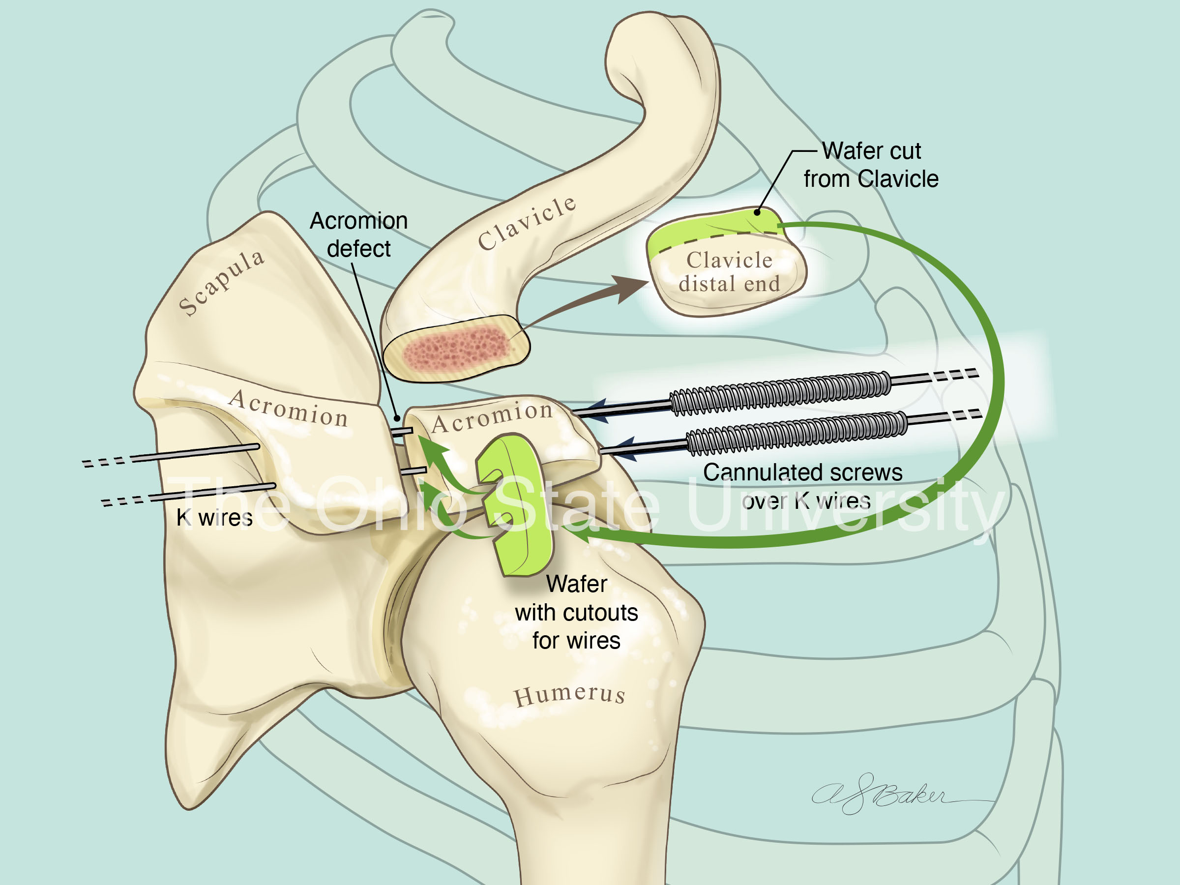 Surgical repair of Os Acromiale (moderate color)