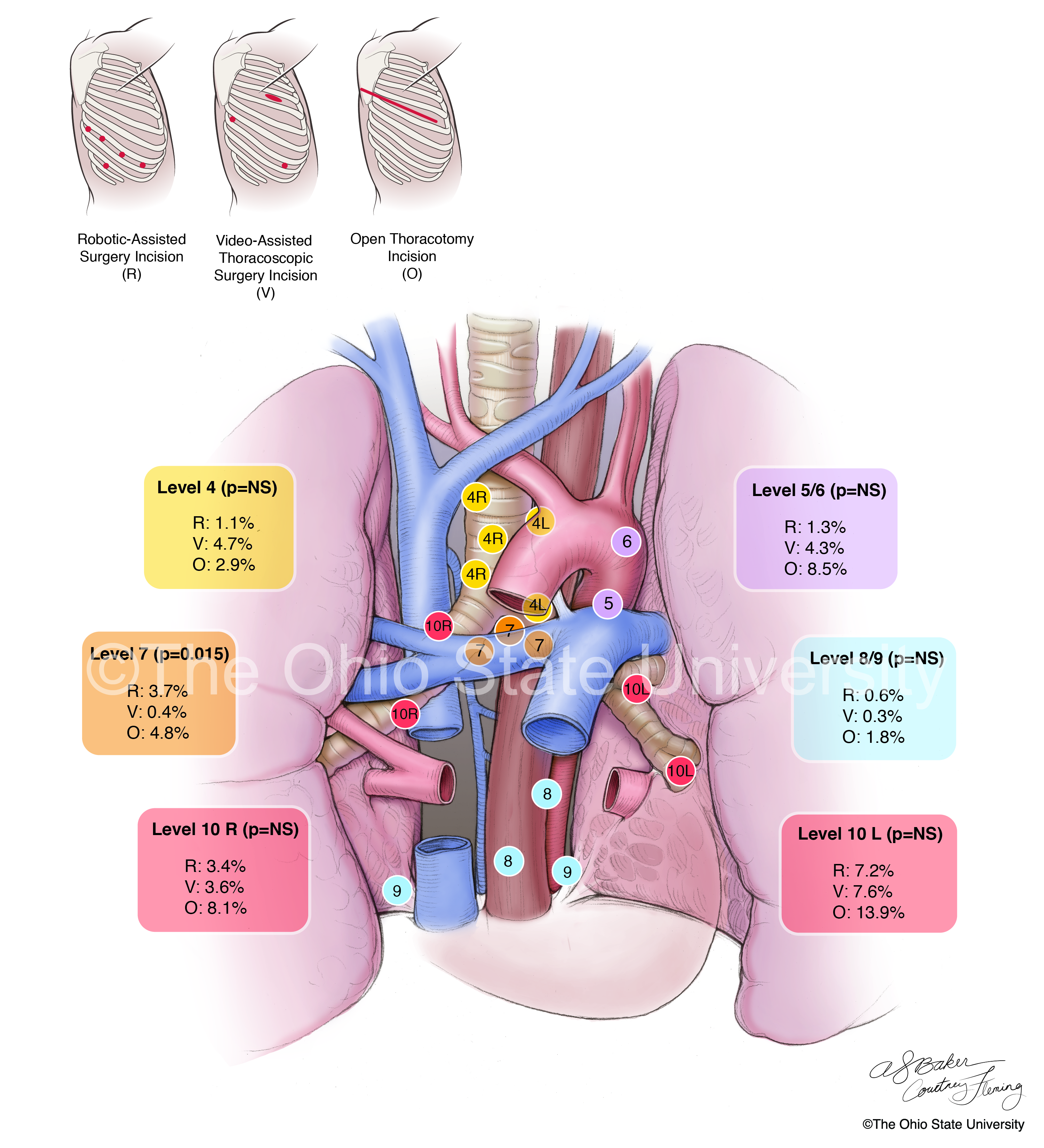 Moderate color surgical illustration, showing thoracic lymph node locations