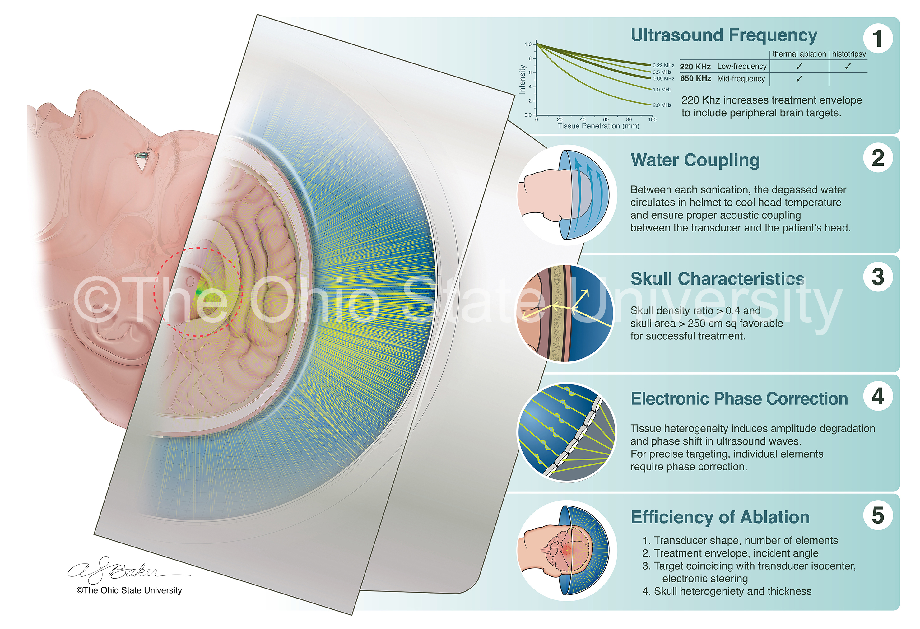 Complex color journal illustration, showing high-intensity focused ultrasound