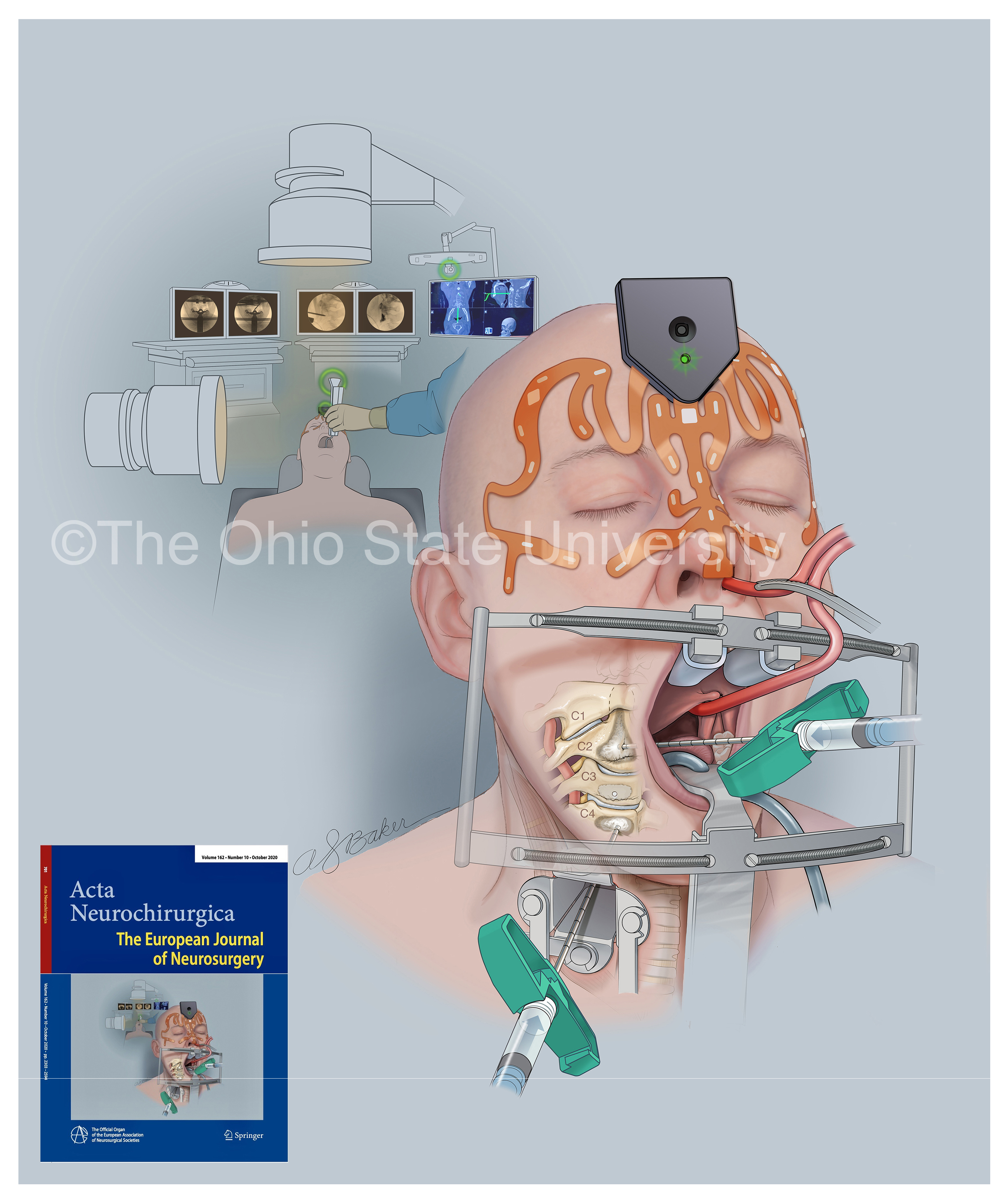 European journal cover art, showing navigation-assisted transoral vertebroplasty