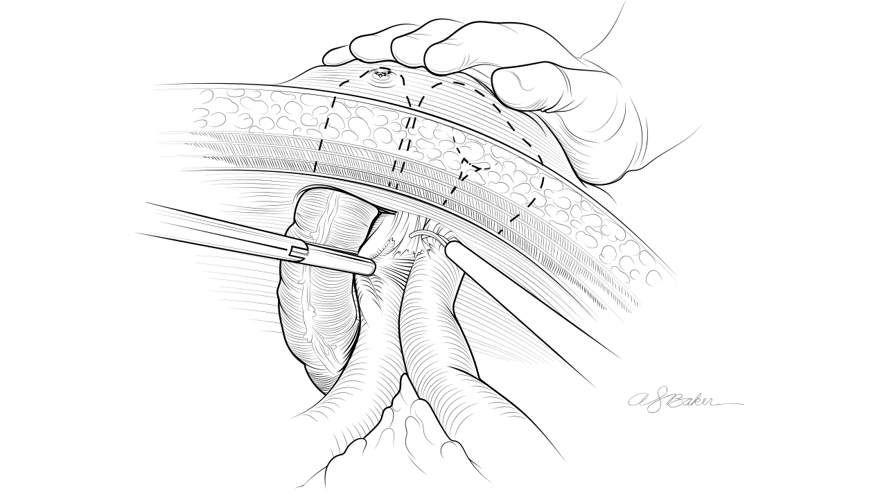 Line drawing cross‑section of the abdominal wall showing layered tissues with instruments retracting deeper structures.