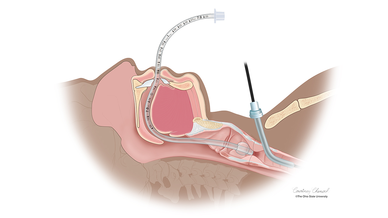 Colored illustration of a tracheal tube inserted in a person.
